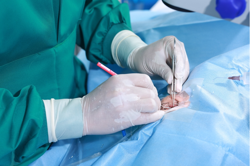 Kỹ thuật phẫu thuật mắt Phaco